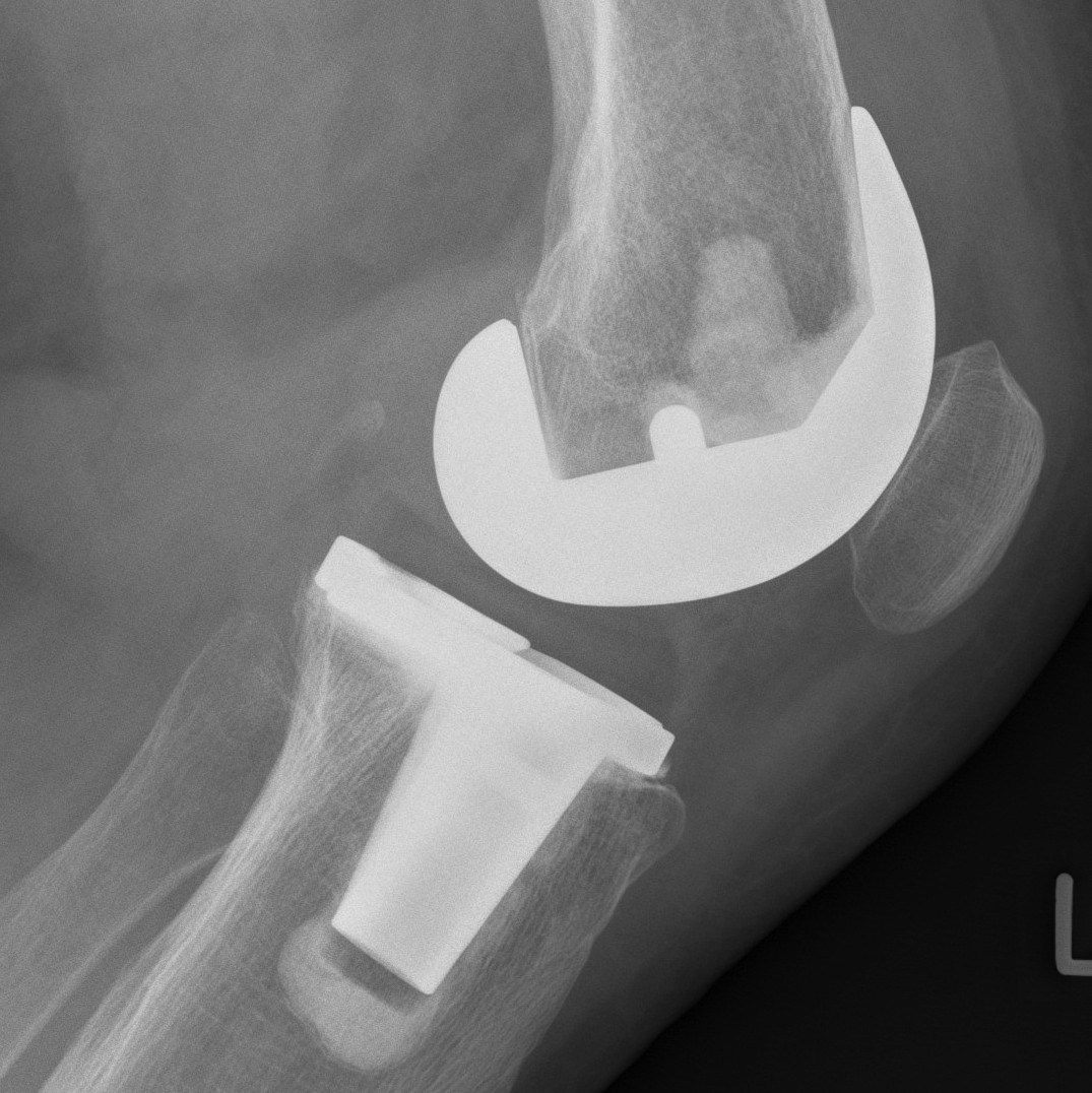 TKR Cruciate Retaining